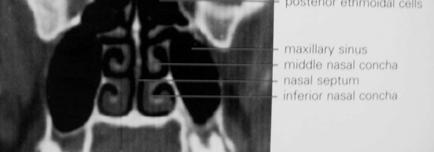 secernente gonadotropine e non secernenti Rari Notevoli dimensioni TERAPIA: Chirurgia Radiochirurgia stereotassica 1.