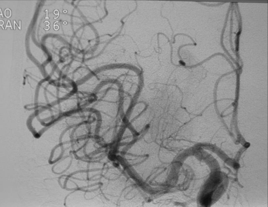 embolectomie meccaniche e trombo aspirazione 234/245 (95.