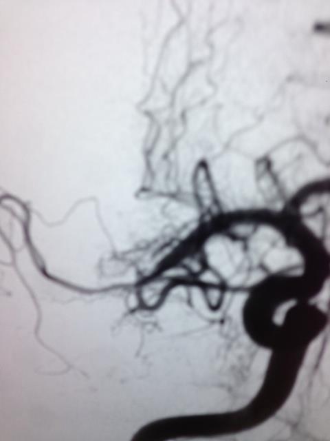 ENDOTHELIAL DENUDATION 73%