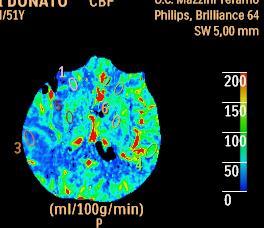 the CBF reduced region (Green in the Summary Maps).