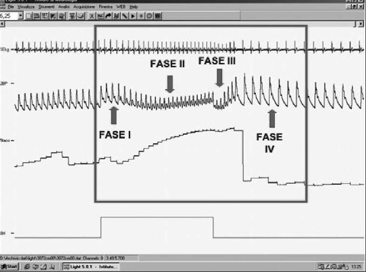 Figura 5: tracciato poligrafico durante manovra di Valsalva Respiro profondo Esplora il sistema efferente parasimpatico.