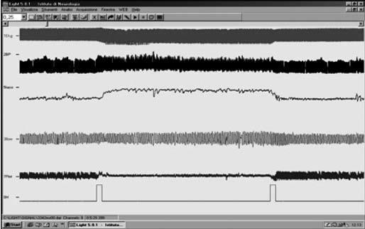 Il tilt test passivo, riducendo la risposta compensatoria dovuta alla contrazione muscolare attiva esagera questo meccanismo e aumenta la sensibilità del test.