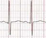 Intervallo QT È misurato dall inizio del QRS al termine della T, onda U esclusa Formula di Bazett QTc= QT/ RR (in sec) QTc 1-16 anni > 16 maschio II-V5-V6 sono le derivazione che meglio si prestano