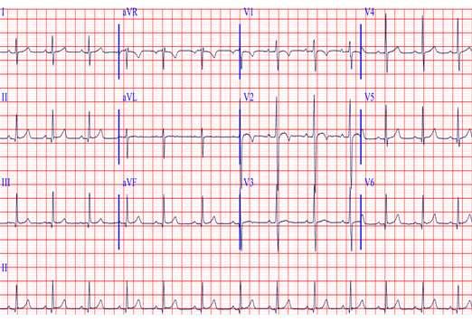 Un ragazzo di 12 anni, atleta, giunge al PS x dolore toracico, modificabile con gli atti del respiro, I genitori insistono perchè venga eseguito un ECG, in quanto a scuola, durante un evento