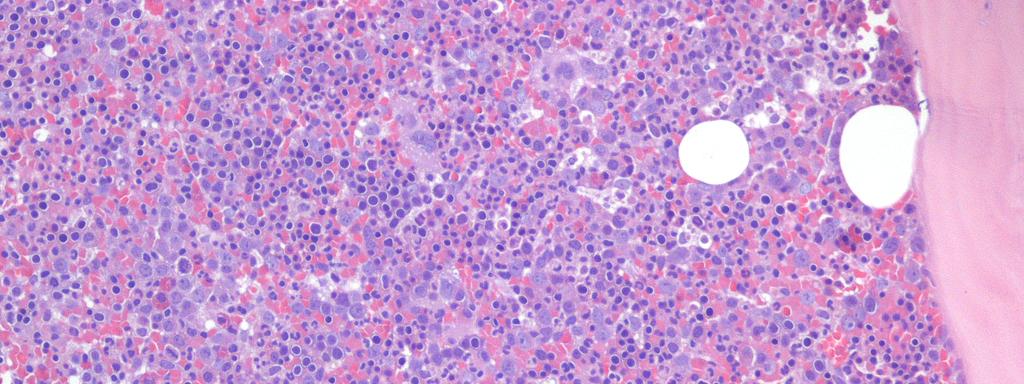 Policitemia vera: neoplasia mieloproliferativa