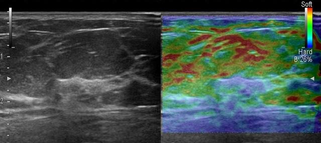 I tessuti adiposi mammari Aspetto B-mode pseudomacronodulare del grasso