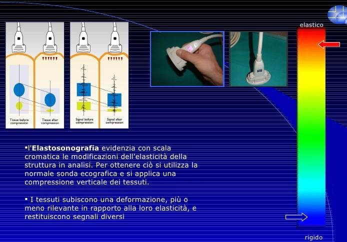 Scopo di questa presentazione è quello di partecipare la mia esperienza nell impiego della Strain Elastosonography (SE), tecnica che valuta il grado di deformabilità dei tessuti superficiali e delle