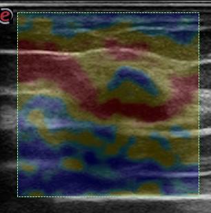 L elastografia mostra un pattern BGR (bleu, green, red) tipico di una cisti corpuscolata. N.