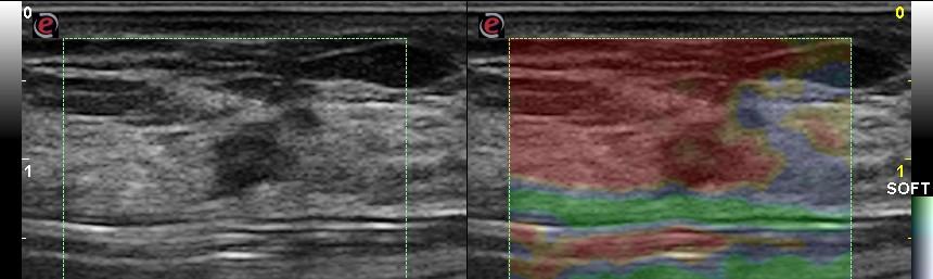 Le lesioni soffici non nodulari Si tratta di reperti non nodulari, che alla SE presentano un pattern di tipo soffice (ES 1-3), di natura verosimilmente infiammatoria o displasica, che non richiedono