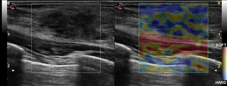 Area di ridotta ecogenicità disomogenea ed a margini sfumati ed irregolari, a sviluppo parallelo al piano cutaneo, senza segni di iperecogenicità perilesionale né attenuazione del fascio US, che all