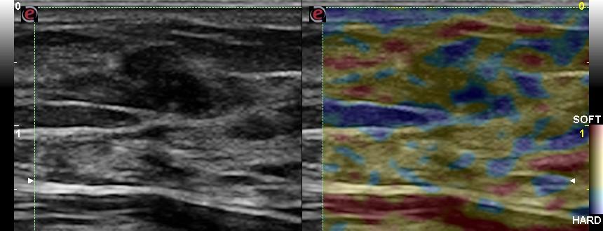 trattarsi di lesione elastica, e la biopsia