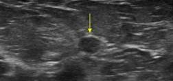 Noduli elastici Si tratta di lesioni nodulari che presentano un parte ES 1-3, quindi