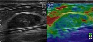 ES 2 (lesione benigna) : fibroadenoma Fibroadenoma con pattern elastografico ES2.