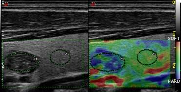 Nodulo ipoecogeno con