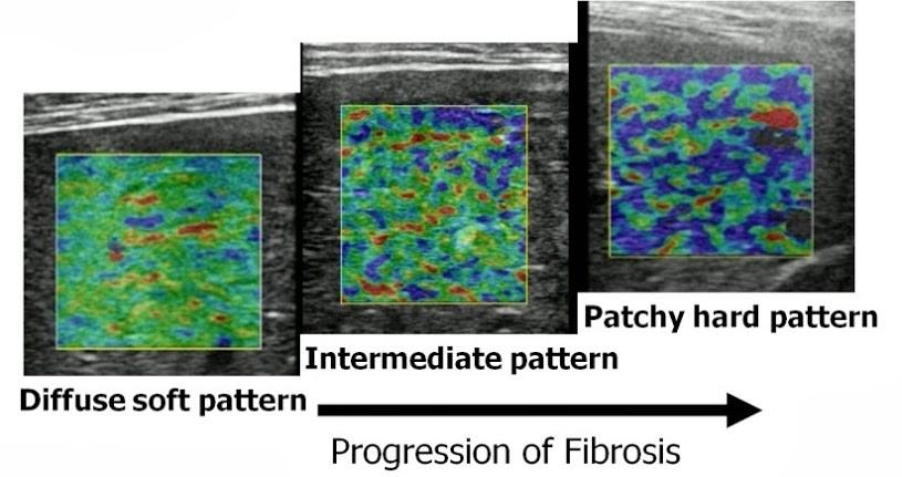 PATOLOGIA EPATICA Sebbene tutt'altro che standardizzata, questa metodologia è stata da taluni esercitata anche nella valutazione, alternativa alla biospia, della fibrosi epatica in corso di