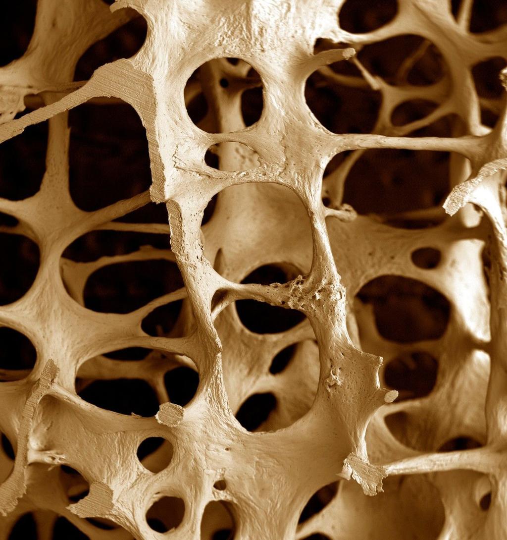 Il Servizio Sanitario Nazionale stima che in Italia l osteoporosi colpisca circa 5.000.000 di persone.