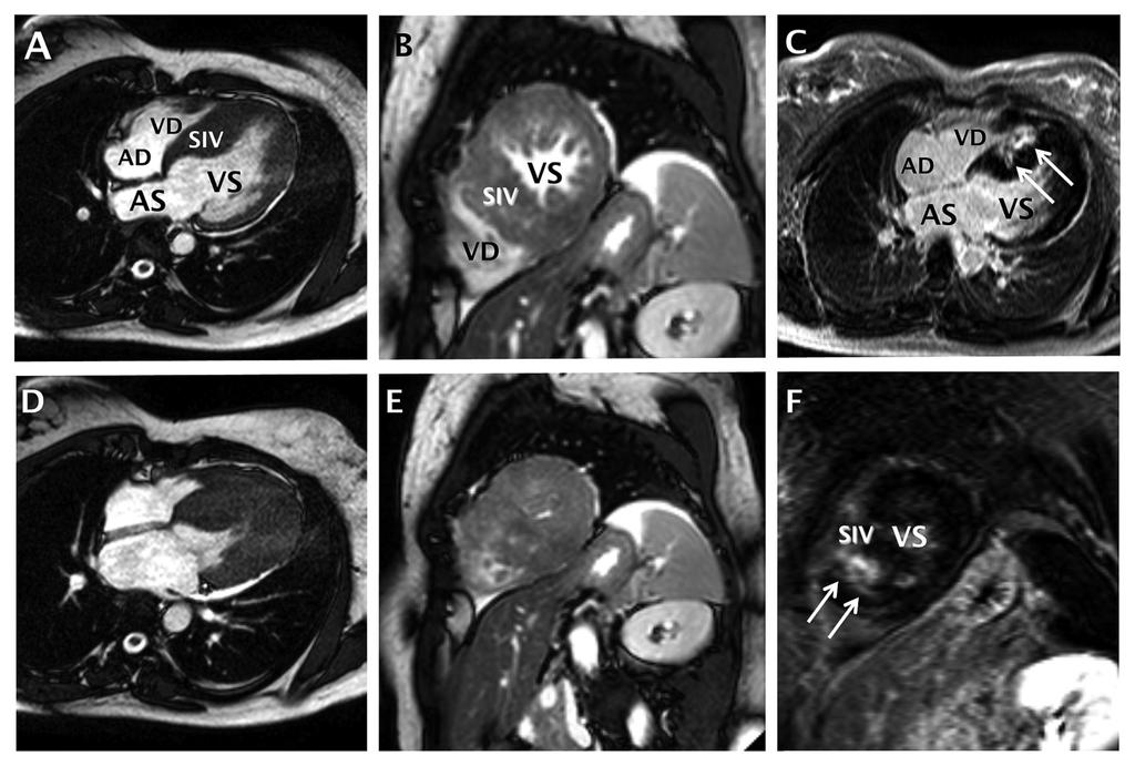 2 Recenti Progressi in Medicina, 102 (12), dicembre 2011 Figura 1. Paziente di 32 anni affetta da Cardiomiopatia Ipertrofica con ipertrofia di grado marcato prevalente a livello medio-apicale.