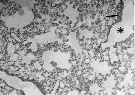 I Basyigit, M Sahin, D Sahin, F Yildiz, H Boyaci, S Sirvanci, F Ercan Montelukast and smoke-induced lung injury Montelukast nel danno polmonare da fumo injury.