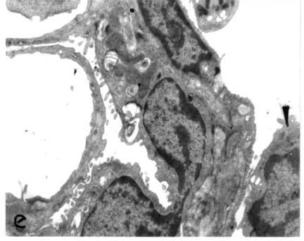 MON control and COPD control groups. ** p < 0.001; healthy controls vs. MON control and COPD control groups. b 4a showing: increase in surfactant deposition in the type 2 pneumocyte ( ).