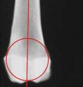 12: Asse anatomico del femore tracciato