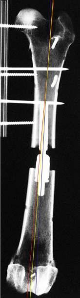 Capitolo 5 Studio sperimentale DISCUSSIONE La conformazione complessa ed irregolare del femore è alla base della confusione presente in bibliografia sulla valutazione dell allineamento di tale