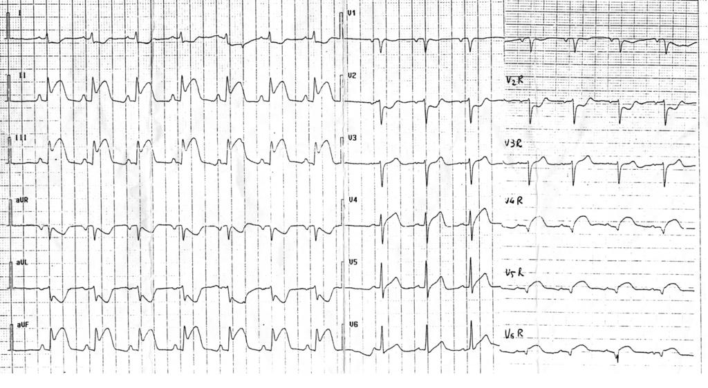 47 Sulle tracce dell ECG: STEMI Isabella Di Zio*, Sossio Serra**, Federica Stella***, Mauro Fallani**** * Dirigente Medico Medicina d urgenza, Pronto Soccorso Ospedale Madonna del Soccorso di San