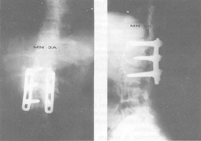 Il trattamento chirurgico delle fratture vertebrali Fig. 5. Fig. 6.