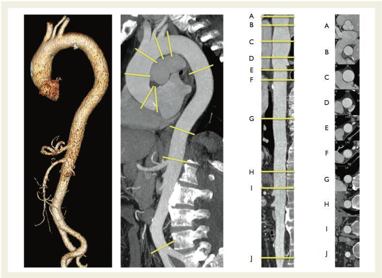 TC ECG-Gated 2014 ESC Guidelines