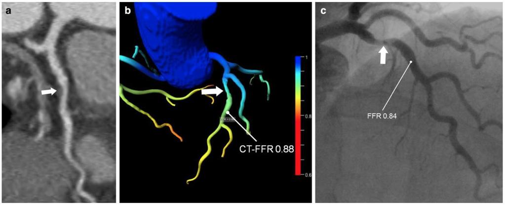 Min JK et al, JACC Cardiovasc