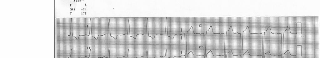 ECG