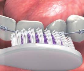 1 2 Inserire la parte rigida del filo GUM Ortho+ direttamente sotto all arco ortodontico.