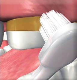 1 Prestare particolare attenzione al bordo gengivale lungo i ponti, effettuando lo spazzolamento con un