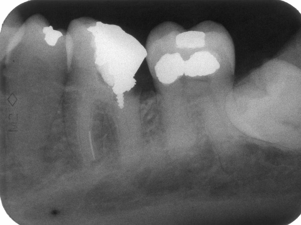 35; introduzione endodontica Endocalex 6-9; otturazione provvisoria; Amoxicillina x os x 4 gg.