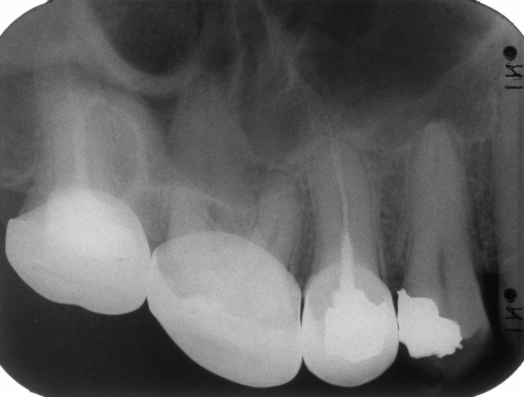 2/10/01 Vite endocanalare + otturazione definitiva in amalgama dʼargento del 15. 4/11/04 Assenza di qualsiasi sintomatologia; xgrafia di controllo. Fig.