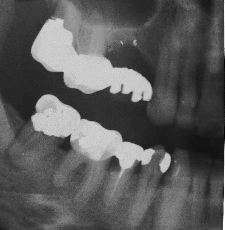 Caso clinico 65 Paziente: C.L. - anni 51 Sesso: F Elementi dentari interessati 26-47 Necrosi pulpare purulenta Amoxicillina 1g x os; 1+1 cpr.