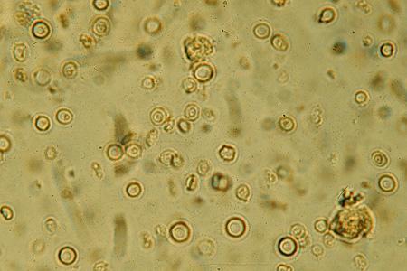 Sedimento urinario Globuli rossi: Hematuria: the