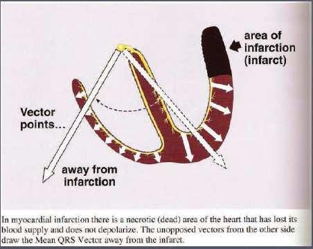 Nell infarto del miocardio vi è un area necrotica del cuore che ha perso la propria irrorazione e