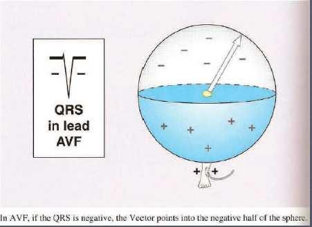 Se in AVF il QRS è negativo il vettore è