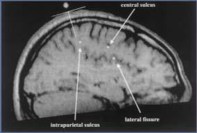 settimane) rtms (10 stimuli a 25 Hz) sui siti parietali P5