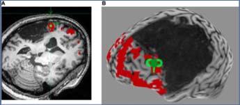 case report / 13 studi di gruppo (2008 2015) tdcs: 18 studi Shah et al.