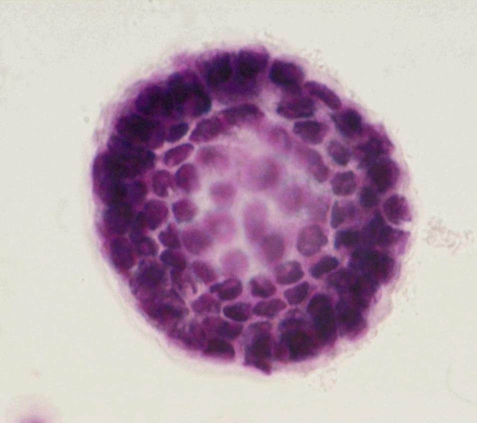 STRUTTURE SFERICHE MESOTELIOMA