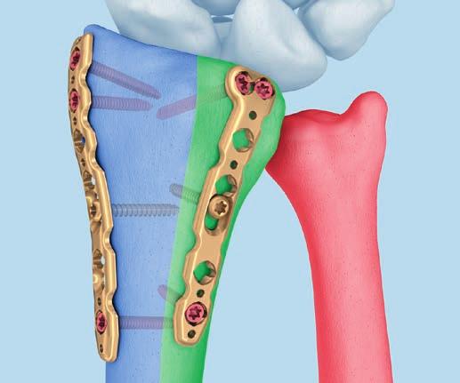 Teoria delle tre colonne Il trattamento delle fratture del radio distale richiede una ricostruzione precisa della superficie articolare, un osteosintesi stabile nonché un trattamento funzionale