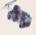 sovrapposizione Nuclei allungati ipercromasia nucleoli sí/no citoplasma scarso