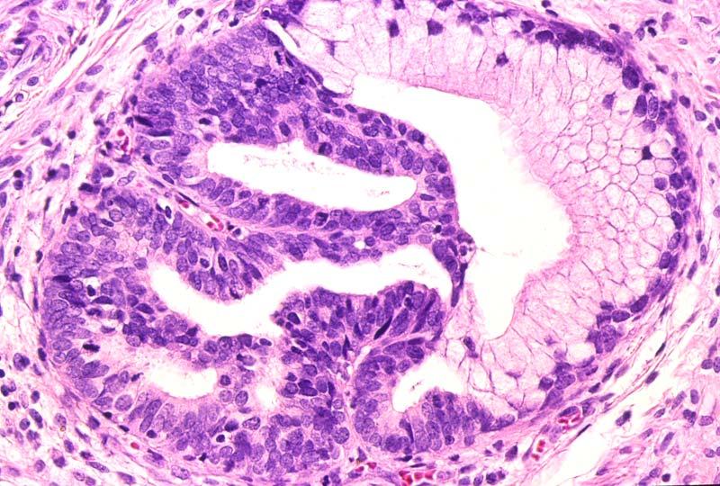 Adenocarcinoma cervicale in-situ Endocervicali con formazione di palizzate di nuclei ipercromici, pseudostratificati Feathering, rosette