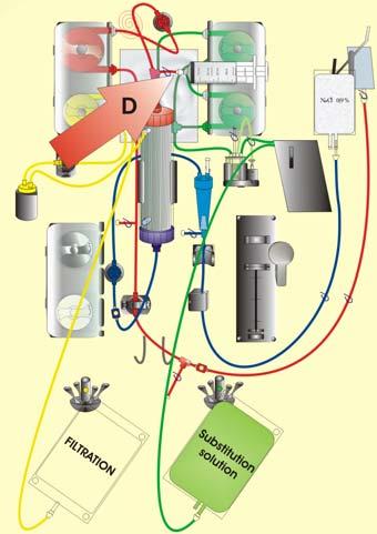 PUNTO 6: Disconnettere la linea di prediluizione dalla porta di accesso di prediluizione se necessario e collegare una siringa vuota da 50 ml o Aquasafe alla porta di accesso prediluizione.