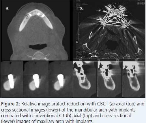 accade nell imaging dentale causa le otturazioni a base di amalgama.