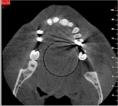 tipo panoramica dentale. Nell utilizzo della modalità panoramica è necessario aver presente che l acquisizione CBCT comporta sempre una esposizione notevolmente superiore (ca.