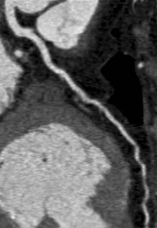 significant coronary artery disease; d score 1, image not evaluable due to severe artefacts. Fig. 1a-d Scala qualitativa per la valutazione dei segmenti coronarici.