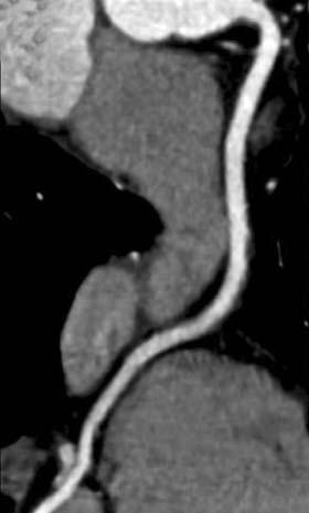Radiol med (2011) 116:178 188 185 a b c Fig. 3a-c Retrospective gating technique. a Right coronary artery; b left anterior descending artery; c circumflex artery. Fig. 3a-c Tecnica di sincronizzazione retrospettica.
