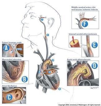 Algoritmo ictus acuto Fase urgenza Sottotipi di Ictus Ischemico A,B,C: embolico: D,E: aterotrombotico; F: lacunare; G: Altre cause; H: Criptogenetico/ESUS Legenda: FA: fibrillazione atriale AOD: